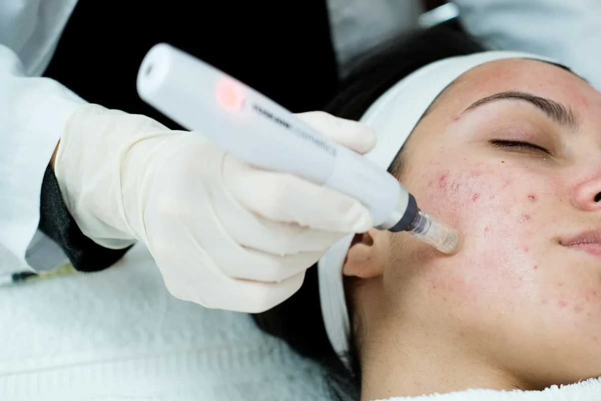 Microneedling Address Both Aging Concerns and Acne Scarring at Once