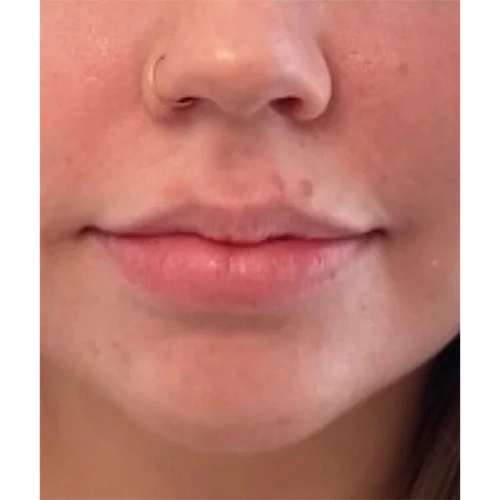 Haus-of-Marin-Lip-filler-Patient-five-after-image Haus-of-Marin-Lip-filler-Patient-five-after-image