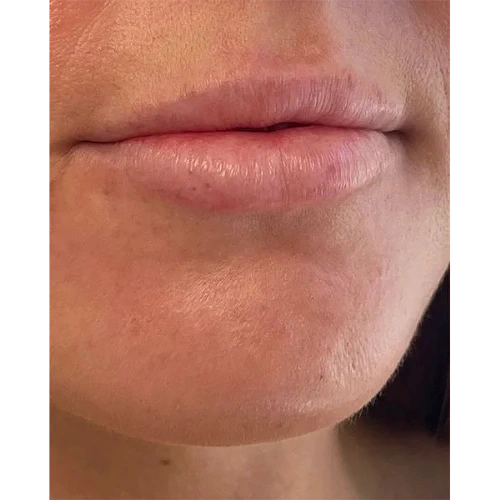 Haus-of-Marin-Lip-filler-Patient-two-before-image-one Haus-of-Marin-Lip-filler-Patient-two-before-image-one