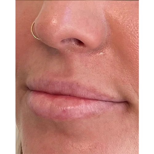 Haus-of-Marin-Lip-filler-Patient-two-before-image-two Haus-of-Marin-Lip-filler-Patient-two-before-image-two